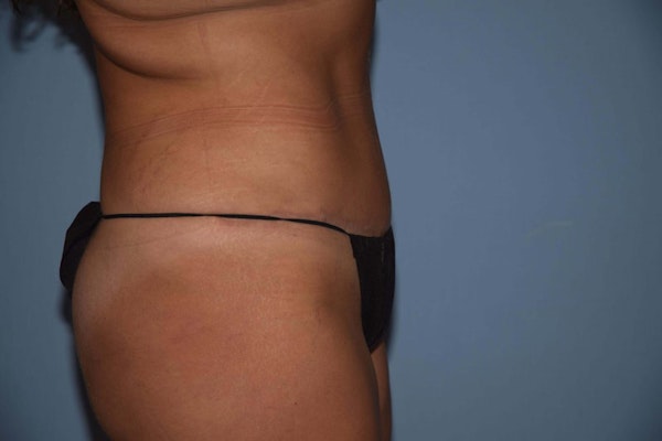 Tummy Tuck Before & After Gallery - Patient 172987 - Image 6