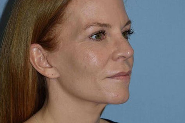 Facelift Before & After Gallery - Patient 228232 - Image 4