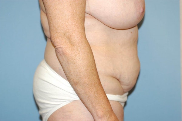 Tummy Tuck Before & After Gallery - Patient 225786 - Image 5