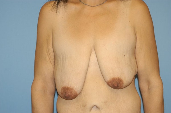 Breast Lift Before & After Gallery - Patient 306053 - Image 1