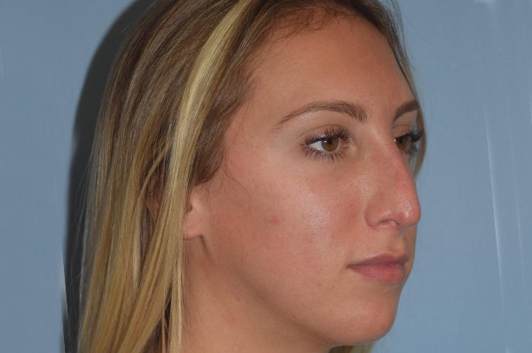 Rhinoplasty Before & After Gallery - Patient 180519 - Image 5