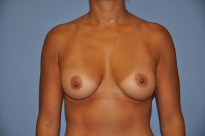 Breast Augmentation Before & After Gallery - Patient 563480 - Image 2