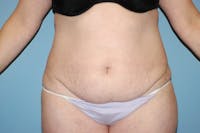 Tummy Tuck Before & After Gallery - Patient 144795 - Image 1
