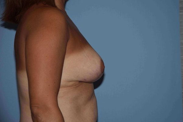 Breast Reduction Before & After Gallery - Patient 363857 - Image 6