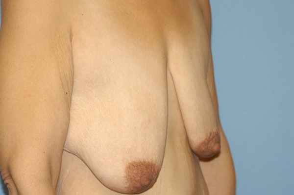 Breast Lift Before & After Gallery - Patient 306053 - Image 3