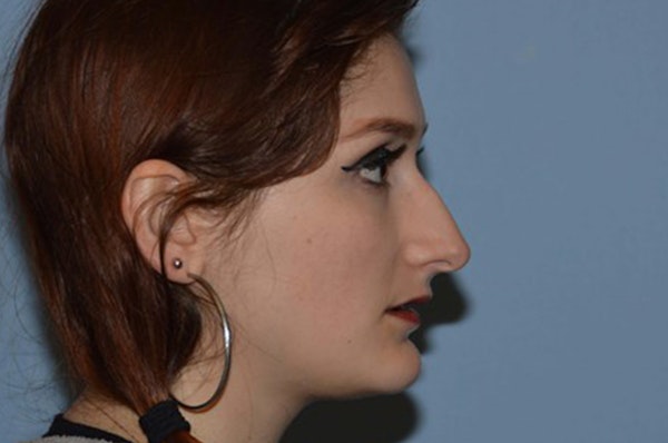 Rhinoplasty Before & After Gallery - Patient 227706 - Image 1