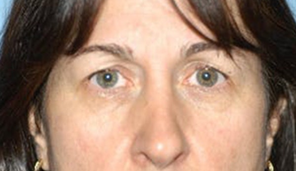 Eyelid Lift Before & After Gallery - Patient 299687 - Image 1