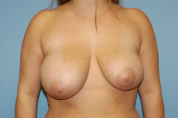 Breast Reduction Before & After Gallery - Patient 732040 - Image 1