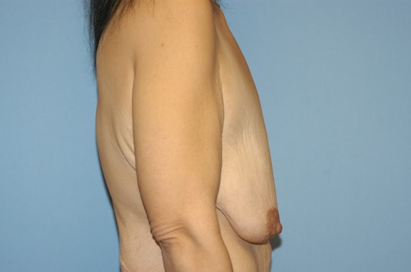 Breast Lift Before & After Gallery - Patient 306053 - Image 5