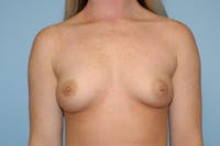 Breast Augmentation Before & After Gallery - Patient 519156 - Image 1