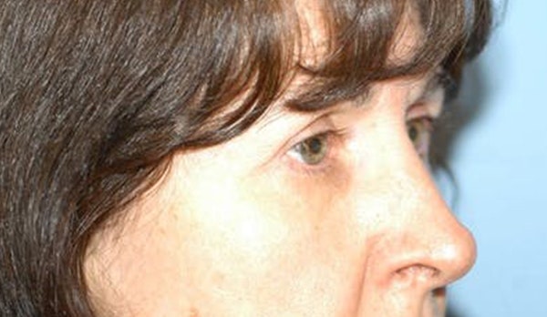 Eyelid Lift Before & After Gallery - Patient 299687 - Image 4