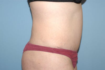 Tummy Tuck Before & After Gallery - Patient 144795 - Image 6