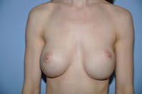 Breast Revision Before & After Gallery - Patient 882280 - Image 1