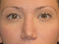Eyelid Lift Before & After Gallery - Patient 366286 - Image 1