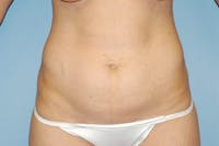 Tummy Tuck Before & After Gallery - Patient 370723 - Image 1