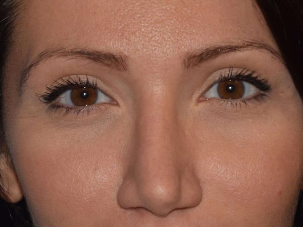 Eyelid Lift Before & After Gallery - Patient 366286 - Image 2