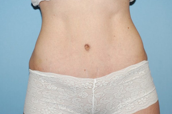 Tummy Tuck Before & After Gallery - Patient 370723 - Image 2