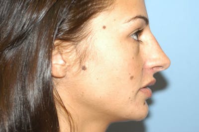 Rhinoplasty Before & After Gallery - Patient 399673 - Image 1