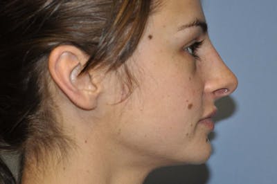 Rhinoplasty Before & After Gallery - Patient 399673 - Image 2