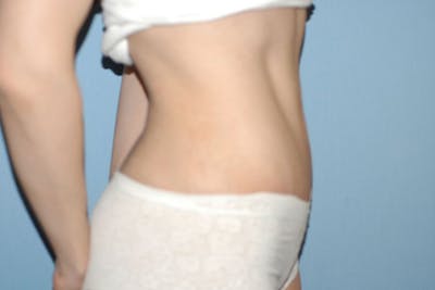 Tummy Tuck Before & After Gallery - Patient 370723 - Image 6