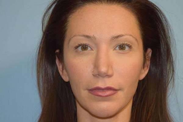 Chin Augmentation Before & After Gallery - Patient 112763 - Image 4