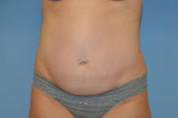 Tummy Tuck Before & After Gallery - Patient 136575 - Image 1