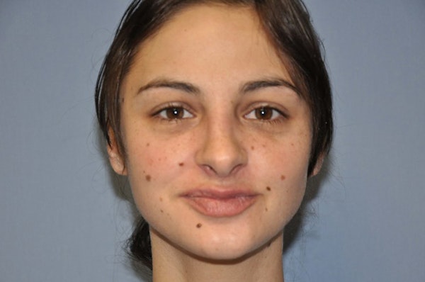 Rhinoplasty Before & After Gallery - Patient 399673 - Image 4