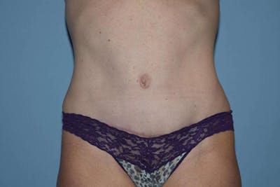 Tummy Tuck Before & After Gallery - Patient 136575 - Image 2