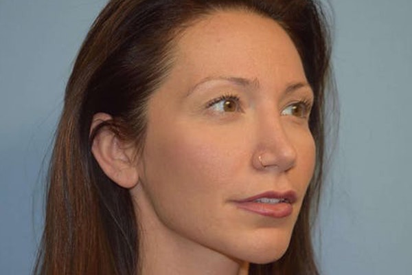 Chin Augmentation Before & After Gallery - Patient 112763 - Image 6