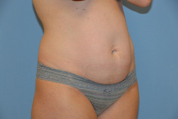 Tummy Tuck Before & After Gallery - Patient 136575 - Image 3