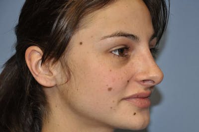 Rhinoplasty Before & After Gallery - Patient 399673 - Image 6