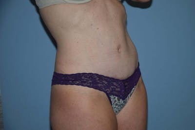 Tummy Tuck Before & After Gallery - Patient 136575 - Image 4