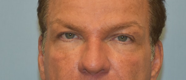 Eyelid Lift Before & After Gallery - Patient 318893 - Image 1