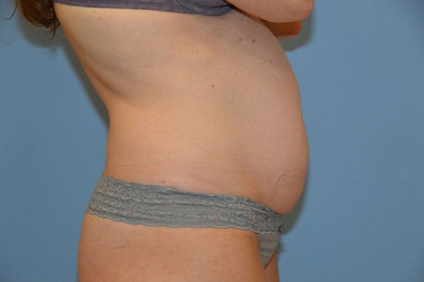 Tummy Tuck Before & After Gallery - Patient 136575 - Image 5