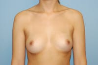 Breast Augmentation Before & After Gallery - Patient 253911 - Image 1