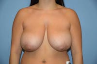Breast Reduction Before & After Gallery - Patient 338733 - Image 1