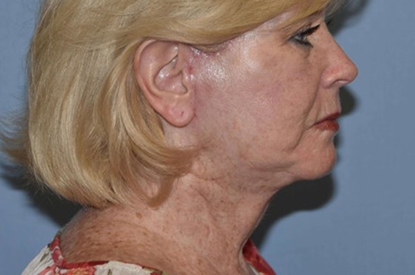 Facelift Before & After Gallery - Patient 191266 - Image 6