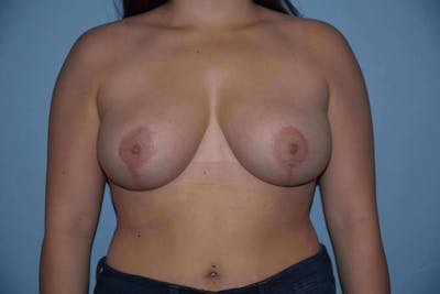 Breast Reduction Before & After Gallery - Patient 338733 - Image 2