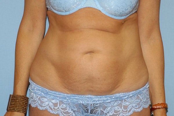 Tummy Tuck Before & After Gallery - Patient 283989 - Image 1