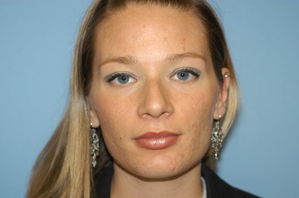 Rhinoplasty Before & After Gallery - Patient 904524 - Image 3