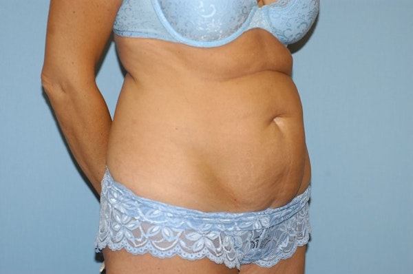 Tummy Tuck Before & After Gallery - Patient 283989 - Image 3