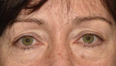Eyelid Lift Before & After Gallery - Patient 417811 - Image 2
