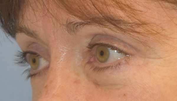 Eyelid Lift Before & After Gallery - Patient 417811 - Image 4