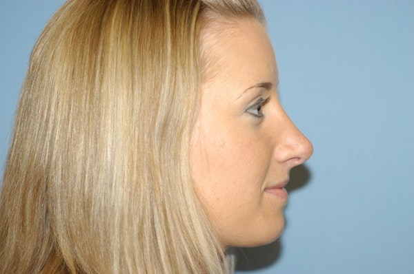 Rhinoplasty Before & After Gallery - Patient 143501 - Image 2
