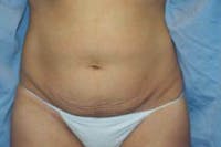 Tummy Tuck Before & After Gallery - Patient 382043 - Image 1