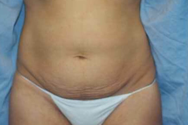 Tummy Tuck Before & After Gallery - Patient 382043 - Image 1