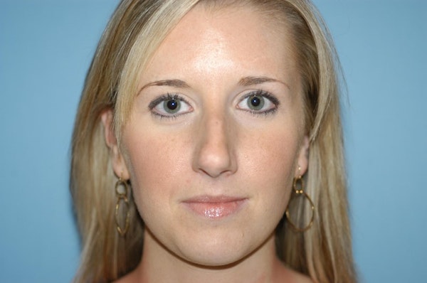 Rhinoplasty Before & After Gallery - Patient 143501 - Image 3