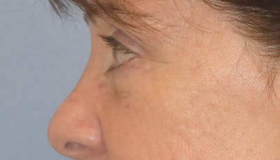 Eyelid Lift Before & After Gallery - Patient 417811 - Image 6