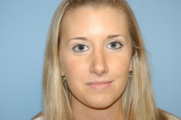 Rhinoplasty Before & After Gallery - Patient 143501 - Image 4