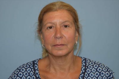 Facelift Before & After Gallery - Patient 317921 - Image 2